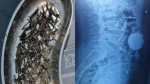 Самарқандда шифокорлар беморнинг қорнидан 200 грамм михни олиб ташлади