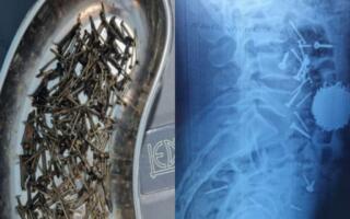 Самарқандда шифокорлар беморнинг қорнидан 200 грамм михни олиб ташлади